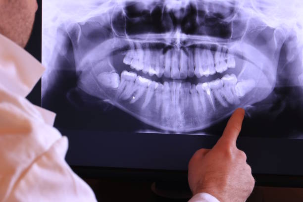 Best Emergency Wisdom Teeth Removal in Marlinton, WV