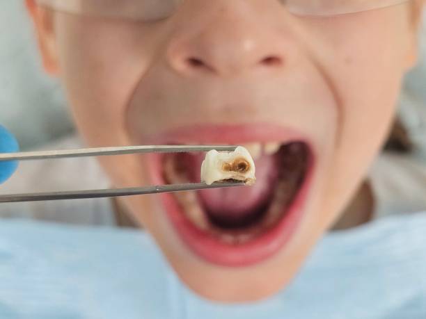 Best Emergency Wisdom Teeth Removal in Marlinton, WV